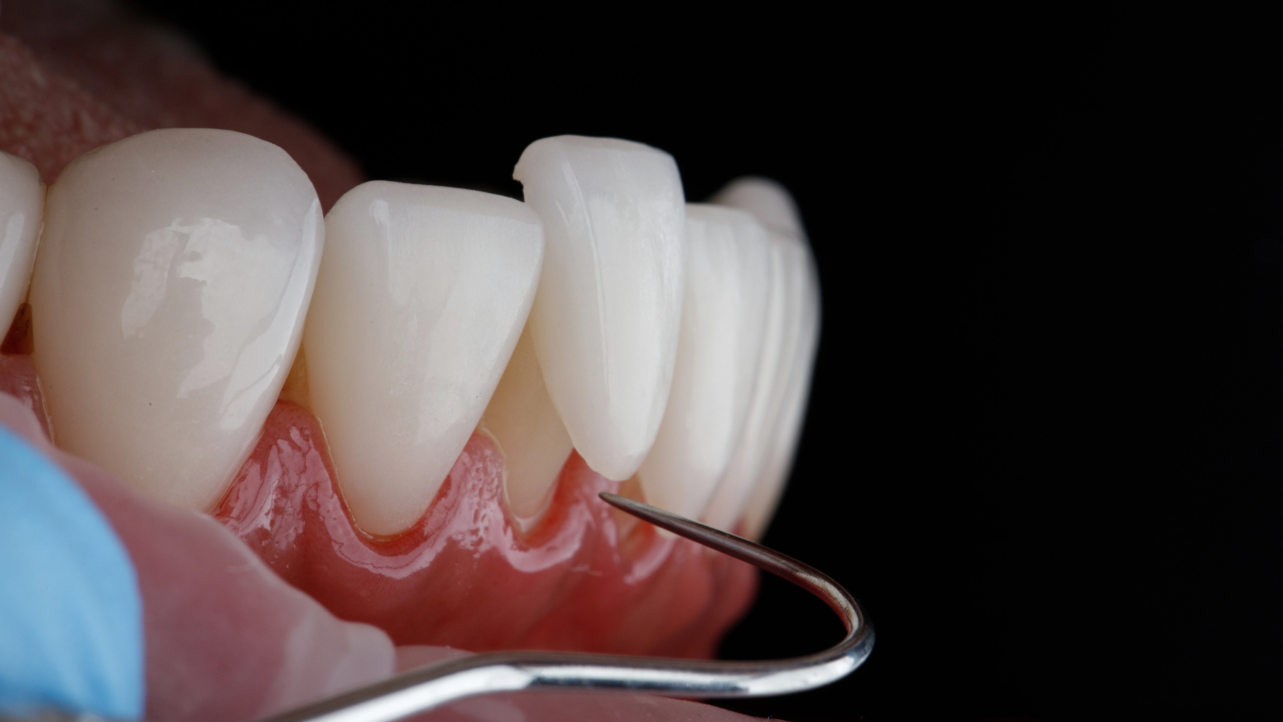 Lentes e Facetas Dentárias em Caxias do Sul